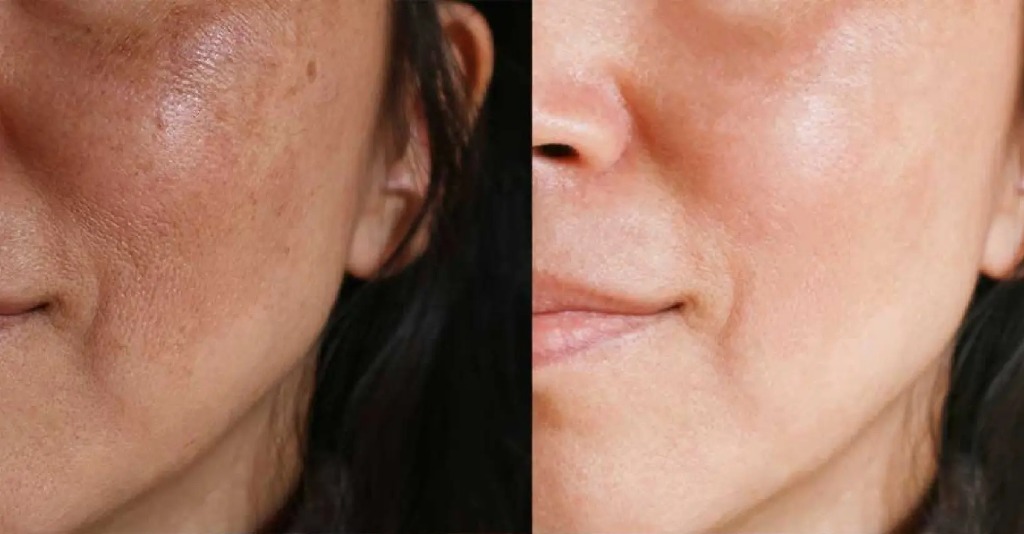 Pigmentation & Melasma